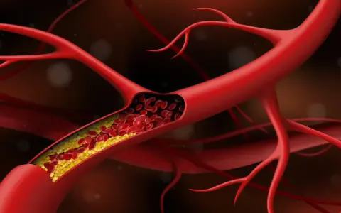 Przekrój naczynia krwionośnego z żółtymi złogami cholesterolu, które powodują, że naczynia krwionośne obkurczają się, utrudniając przepływ krwi.