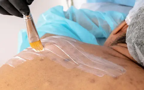 Profesjonalna mezoterapia na trądzik. Kosmetolog nakłada białą maskę na skórę pacjenta pędzlem.