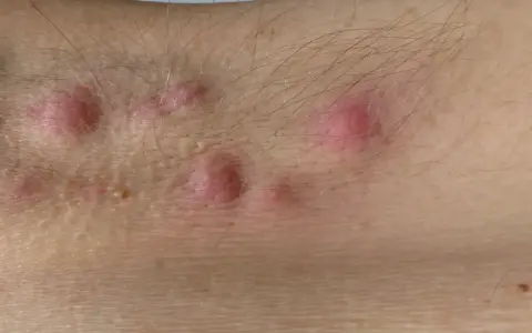 Skóra z kilkoma czerwonymi, zapalnymi zmianami i włosami.