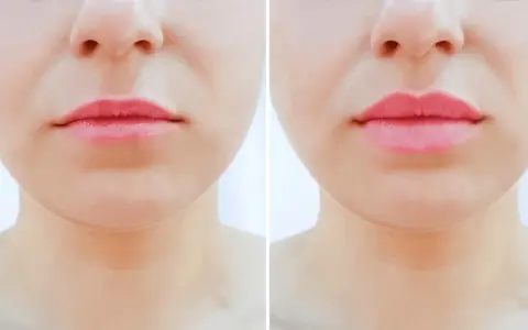 Przed i po zabiegu: usta po lip flip. Zobacz opinie i efekty.