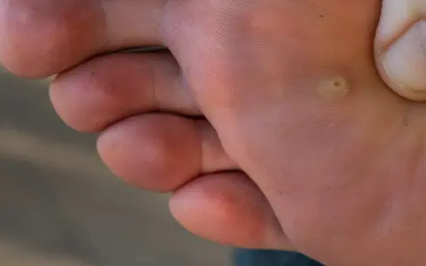 Gros plan sur la plante d'un pied, montrant les empreintes digitales de la peau et une petite verrue au pied.
