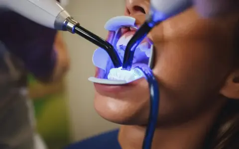 Jak wygląda wybielanie zębów u dentysty? Przewodnik krok po kroku