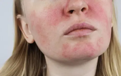 Nahaufnahme eines Gesichts mit Rötungen und sichtbaren Poren, die auf Rosacea und fettige Haut hindeuten.