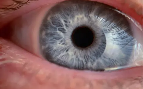 Occhio azzurro con iride dettagliata. Il trabeculectomia decorso post operatorio è in fase di guarigione, mostrando un occhio sano e vigile.