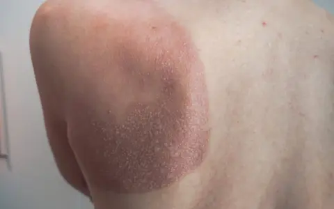 Une petite cloque d'eau sur la peau, signe d'un coup de soleil. La zone affectée est rouge et légèrement écailleuse.