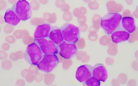 Cellule immature viola, indicative di leucemia linfoblastica acuta, circondate da globuli rossi.
