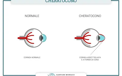 Confronto tra occhio normale e occhio con cheratocono, evidenziando la cornea assottigliata e a forma di cono, uno dei principali cheratocono sintomi.