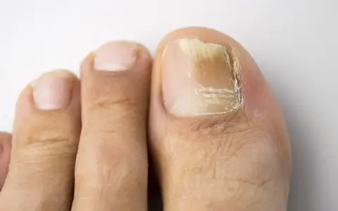 Gros plan sur un ongle de pied atteint de mycose, jauni et épaissi. Une solution naturelle à base d'huile essentielle pourrait aider.