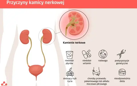 Kolka nerkowa: objawy, ból nie do zniesienia? Kiedy pilnie do szpitala?