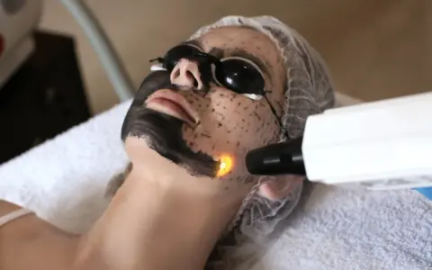 Kobieta z maską węglową na twarzy przechodzi zabieg laserowy.