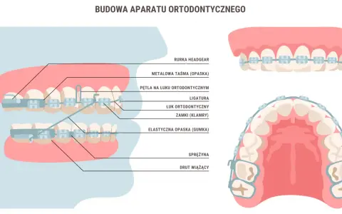 Aparat ortodontyczny a wypadanie zębów: Prawda czy mit?