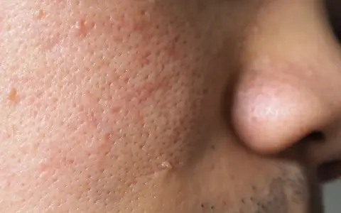 Gros plan sur la peau d'un visage, montrant des pores dilatés et une petite verrue sur la joue.