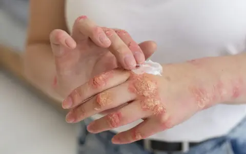 Manos con psoriasis, aplicando crema para aliviar la piel seca y escamosa.