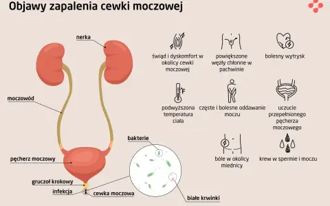 Objawy zapalenia cewki moczowej (ICD-10): pieczenie, ból, gorączka, krew w moczu, powiększone węzły chłonne.