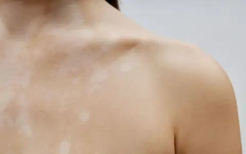 Piel con manchas claras, como si fueran **hongos en la espalda**, cubriendo el cuello y hombro.