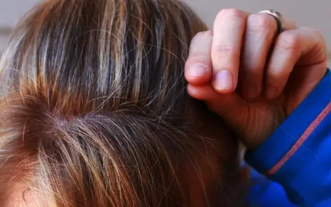 Dita che tirano i capelli, un gesto comune nella tricotillomania, a volte associata all'autismo.