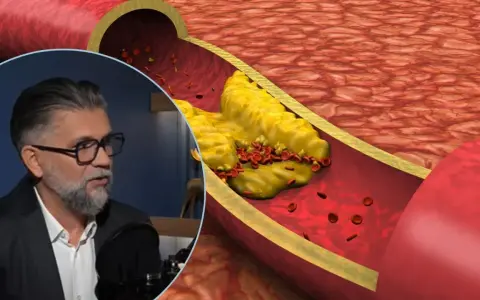 Mężczyzna w okularach opowiada o tym, jak wyleczył miażdżycę, podczas gdy na ekranie widać przekrój tętnicy z cholesterolem i czerwonymi krwinkami.