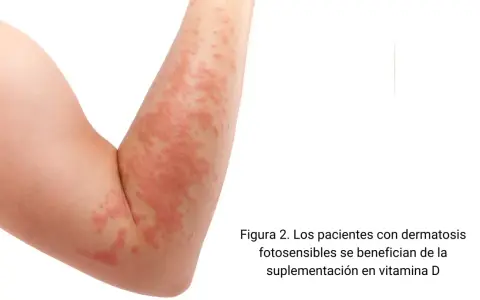 Brazo con erupción cutánea roja y escamosa.