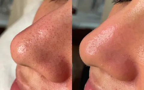 Before and after a hydro infusion facial, showing a nose with visible pores and blackheads transformed into smoother, clearer skin.