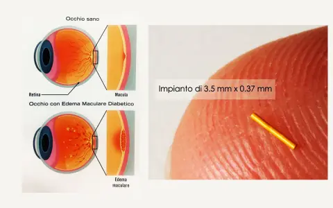Illustrazione occhio sano vs. occhio con edema maculare diabetico, causa di edema retinico. Impianto microscopico.