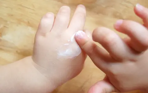 Mani di bambino applicano crema, un gesto che aiuta a contrastare la pelle atopica, alleviando secchezza e prurito.