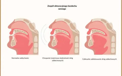 Ilustracja pokazuje przekrój dróg oddechowych: normalne oddychanie, chrapanie (częściowa niedrożność) i całkowite zablokowanie, które może powodować brak oddechu w nocy nerwica.