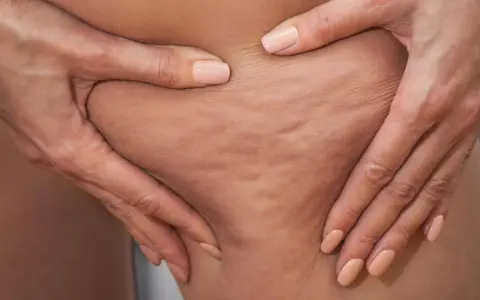 Hände greifen in die Haut an den Oberschenkeln, um Cellulite an den Beinen zu zeigen.