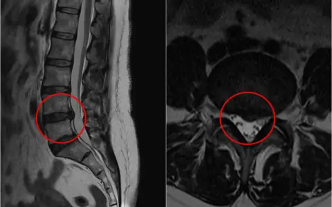 MRI kręgosłupa lędźwiowego z zaznaczoną przepukliną. Czy przepuklina kręgosłupa jest groźna? Obraz pokazuje, że tak, może uciskać nerwy.