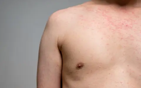 Eruzione cutanea rossa sul petto e sulla spalla, forse causata da un tessuto sintetico. L'elastan fa male alla pelle sensibile.