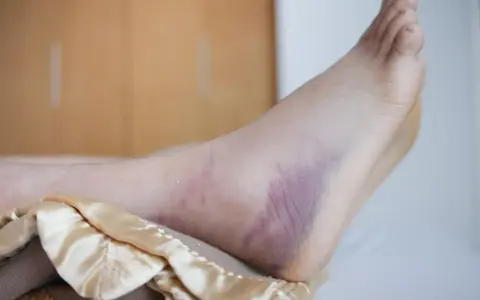 Stopa z widocznymi sinymi przebarwieniami, które mogą być objawem rany cukrzycowej.