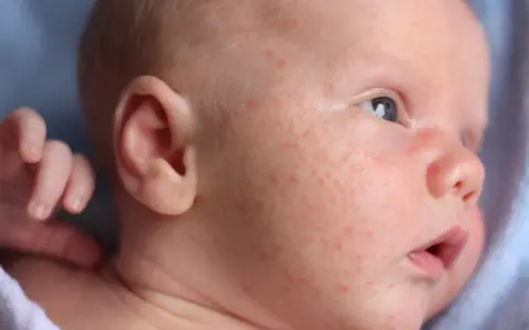 Nahaufnahme eines Babys mit roten Pickelchen im Gesicht. Die Frage "Babyakne wie lange" beschäftigt viele Eltern.