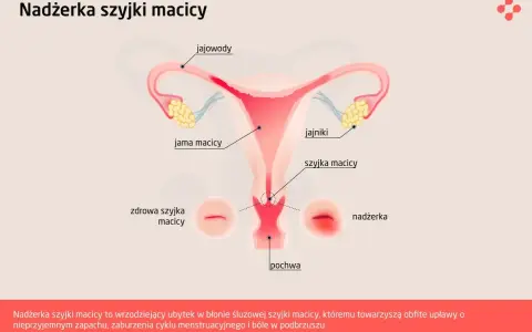 Ilustracja przedstawia budowę narządów rodnych kobiety z zaznaczoną nadżerką szyjki macicy, która jest wrzodziejącym ubytkiem.