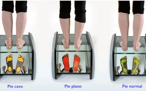 Análisis de pisada: pie cavo, pie plano y pie normal. Las huellas muestran la presión en cada tipo de pie.