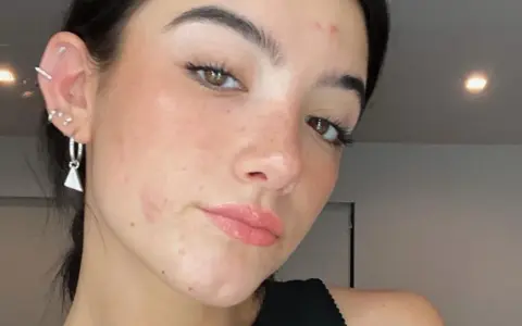 Gros plan sur le visage d'une jeune femme aux yeux marron, avec un bouton sur le front et des boucles d'oreilles.