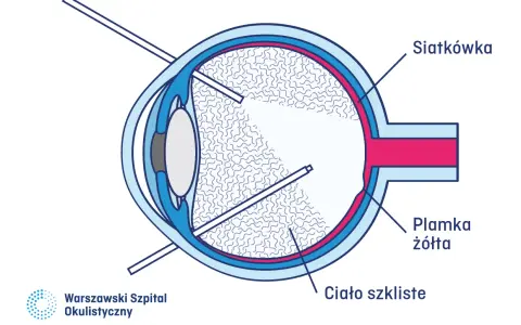 Schemat oka z zaznaczoną siatkówką, plamką żółtą i ciałem szklistym. Unikaj urazów, które mogą prowadzić do odwarstwienia siatkówki.