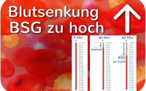 Blutsenkung: BSG zu hoch. Rote Blutkörperchen und Messzylinder zeigen eine erhöhte BSG an, was auf Entzündungen hindeuten kann.