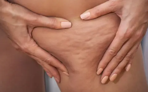 Gładkie uda bez cellulitu? Mój plan: dieta, ćwiczenia, zabiegi