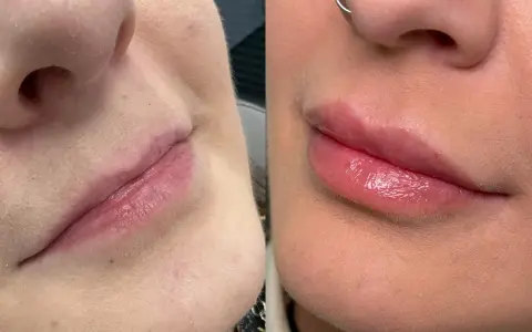 Powiększanie ust: Kwas hialuronowy, lip lift czy domowe triki?