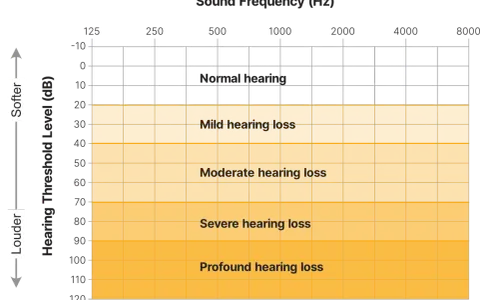 Graphique montrant les niveaux de perte auditive en fonction de la fréquence et du bruit decibel. De "normal hearing" à "profound hearing loss".