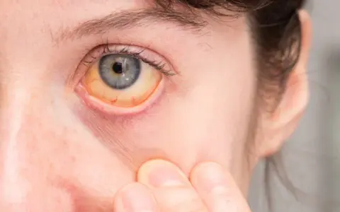 Jadłowstręt psychiczny objawy: jak rozpoznać niebezpieczne symptomy