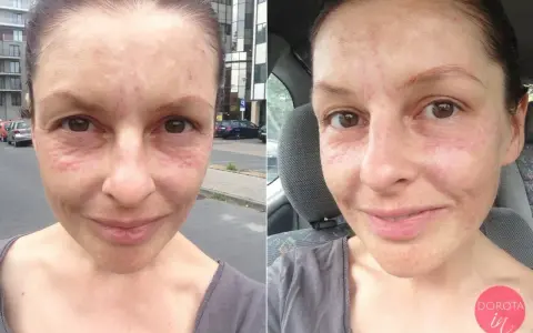 Woda po kwasie hialuronowym: jak pić, by efekty zachwycały?
