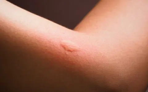 Gros plan sur un bras humain montrant une réaction cutanée rouge et enflée, typique d'une allergie ou d'un bouton de moustique.