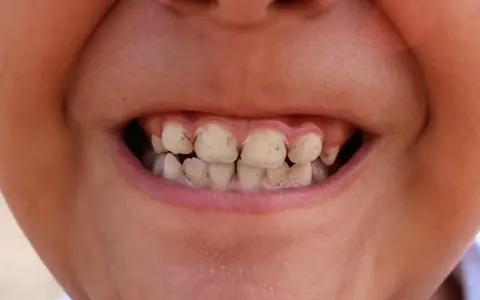 Zęby z widocznym kamieniem nazębnym i oznakami próchnicy.