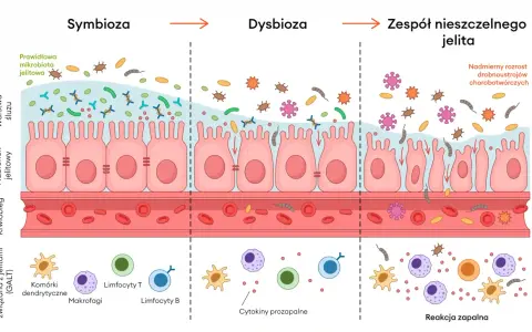 Ilustracja pokazuje, co to jest immunologia jelitowa: od symbiozy, przez dysbiozę, po zespół nieszczelnego jelita i reakcję zapalną.