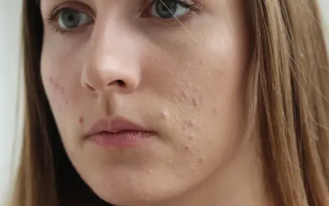 Młoda kobieta z niedoskonałościami na twarzy, być może stosująca sudocrem na twarz.
