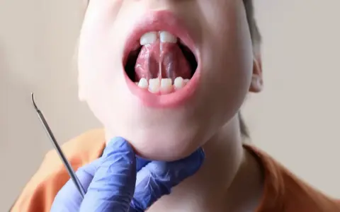 Dziecko otwiera usta, pokazując język przyrośnięty do dna jamy ustnej. Widoczny fragment wędzidełka językowego, które może wymagać podcięcia.