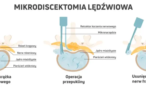 Ilustracja pokazuje mikrodiscektomię lędźwiową: przepuklinę, operację i usunięcie fragmentu krążka. Pamiętaj, czego nie wolno robić po operacji kręgosłupa lędźwiowego.