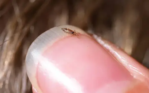 Un pidocchio, pronto per il trattamento, si muove su un'unghia.