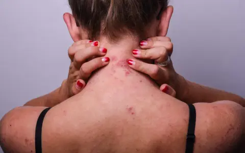 Vue arrière d'une personne se grattant le cou et le haut du dos, montrant des rougeurs et des irritations dues à l'eczéma.