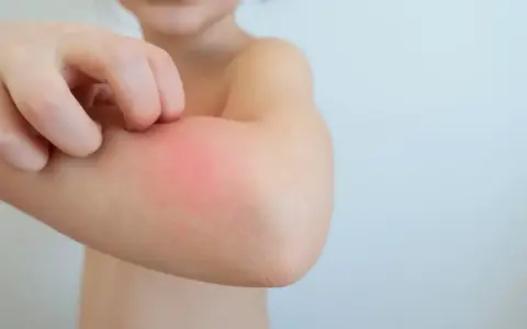 Kind kratzt sich am roten, geschwollenen Arm. Tipps, wie man Schnakenstiche behandeln kann, sind hier wichtig.